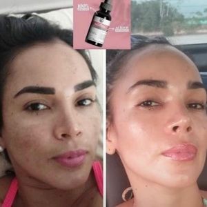 Tónico Despigmentante 🇨🇴 *Eliminador de manchas* Removes dark spots + acne